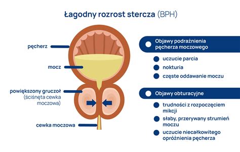 infografika przedstawiająca anatomię prostaty i jej umiejscowienie