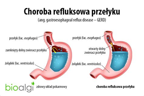 Infografika: Choroba refluksowa przełyku - objawy i mechanizm powstawania