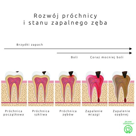 Schemat przedstawiający przyczyny konieczności ekstrakcji zęba (zaawansowana próchnica, urazy mechaniczne, stany zapalne)